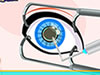 Cinderella Eye Surgery