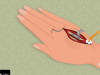 Hand surgery